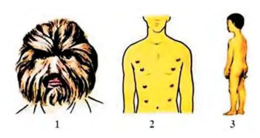 122-rasm. Odamdagi atavizm hodisasi. 1 – sherbashara odam; 2 – ko‘p emchakli bola; 3 – dumli bola.