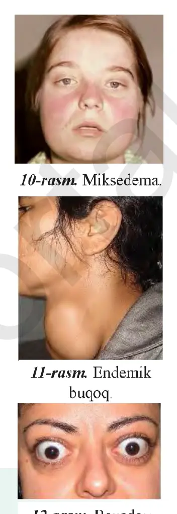 10-rasm. Miksedema. 11-rasm. Endemik buqoq. 12-rasm. Bazedov kasalligi.
