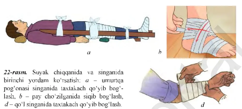 22-rasm. Suyak chiqqanida va singanida birinchi yordam ko‘rsatish: a – umurtqa pog‘onasi singanida taxtakach qo‘yib bog‘lash, b – pay cho‘zilganida siqib bog‘lash, d – qo‘l singanida taxtakach qo‘yib bog‘lash.