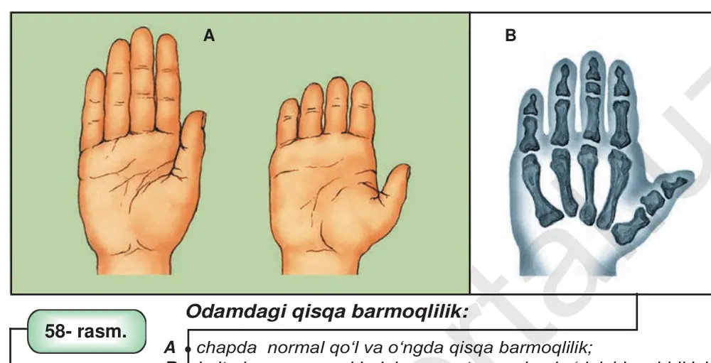 58- rasm. Odamdagi qisqa barmoqlilik: A chapda normal qo‘l va o‘ngda qisqa barmoqlilik; B kalta barmoq suyaklarining orqa tomondan ko‘rinishi va birikishi.